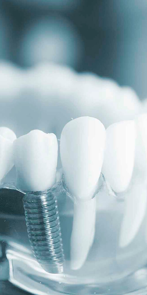 Implantes Dentários em Presidente Prudente SP